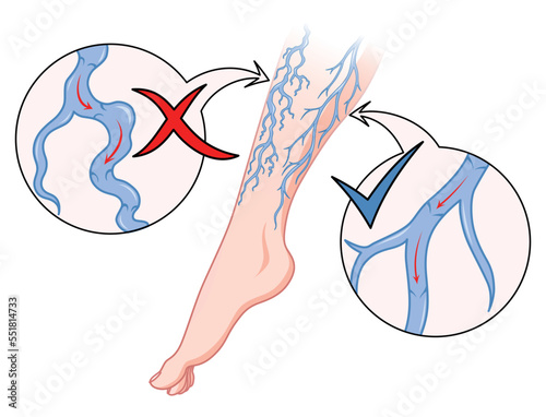 Varicose veins. Blue blood vessel visible through the skin, abnormally swollen leg. Vascular disease diagnostic and treatment. Venous insufficiency medical flat
