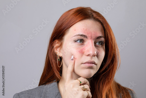 Valokuva Fair skinned young woman suffering from rosacea