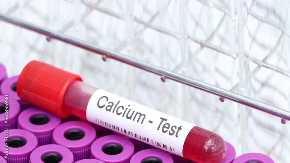Video „calcium test to look for abnormalities from blood, blood sample