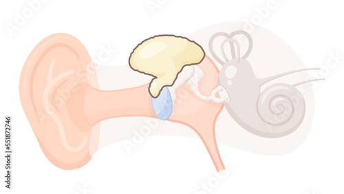 真珠腫性中耳炎のイラスト_上鼓室型真珠腫 photo