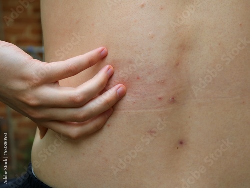 the back of a young man or teenager covered with itchy red inflammations and a hand reaching for them, acne on the skin during puberty, malnutrition and poor body hygiene