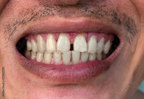 Huge gap between the front teeth or incisors of Asian Chinese man. Diastema.