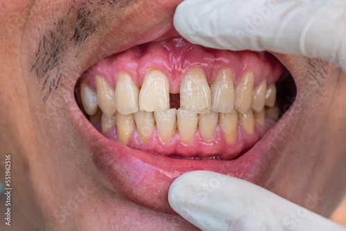 Quadro em tela Huge gap between the front teeth or incisors of Asian Chinese man