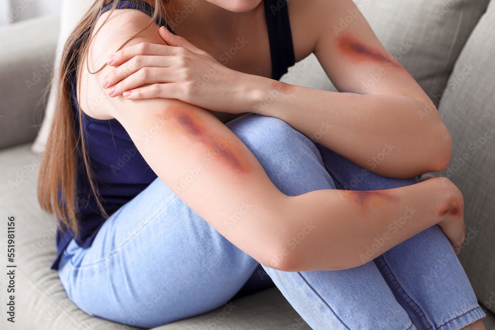 Fototapeta premium Young woman with bruised arms sitting on sofa at home, closeup