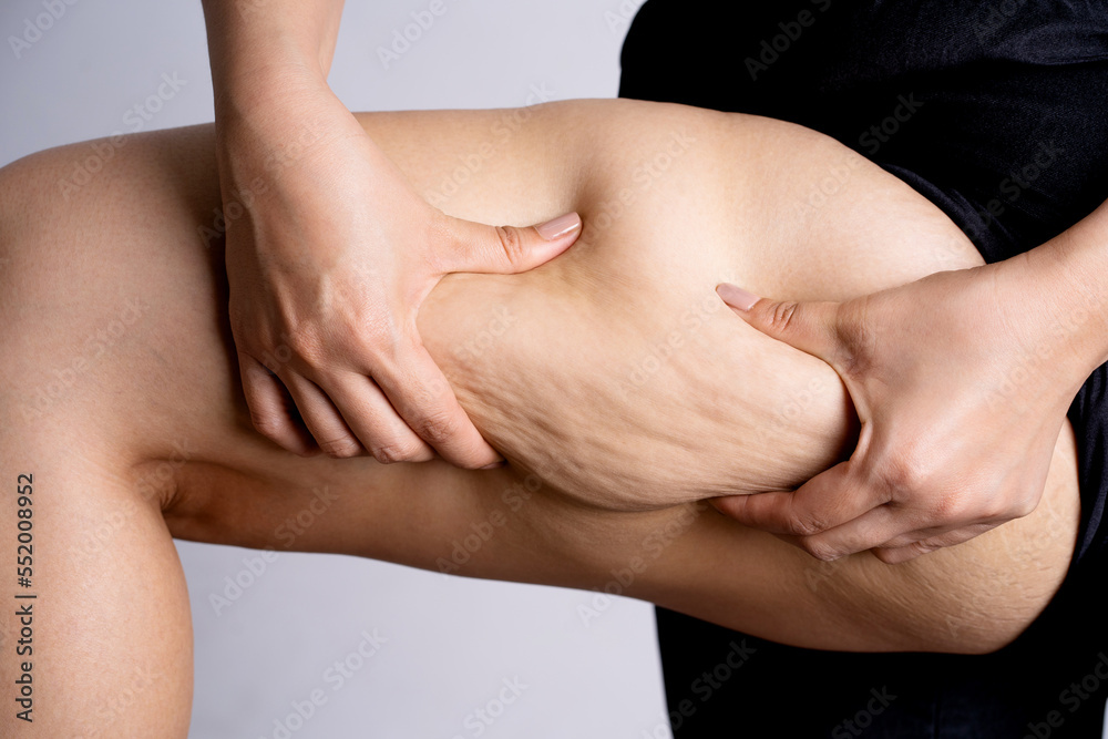 Cellulite leg woman pinch. Test fat hips treatment. Over weight liposuction.