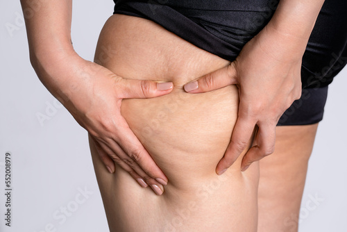 Woman showing cellulite on legs like orange peel skin The concept of treatment and elimination of excess weight.