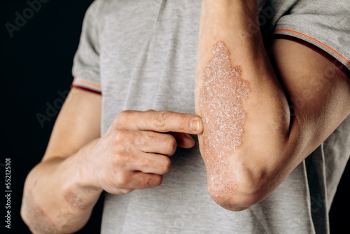 Acute psoriasis on the elbows is an autoimmune incurable dermatological skin disease. A large red, inflamed, flaky rash on the elbows. Joints affected by psoriatic arthritis photo