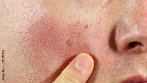 Red face, broken capillaries, health problems, sensitive skin