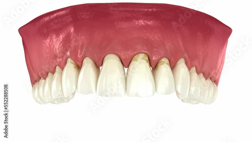 Periodontitis and gum recession in dynamics, teeth losing. Dental 3D animation photo