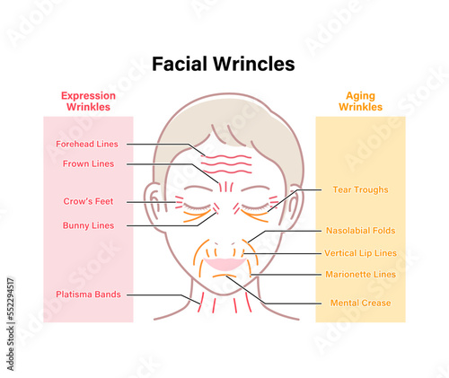 Expression wrinkles and Aging wrinkles ( female face ) vector illustration