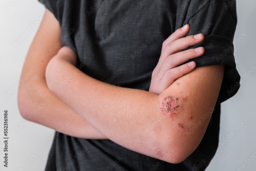 teenager scratching his hand with allergic lesions on the skin.skin of the hands with red wounds