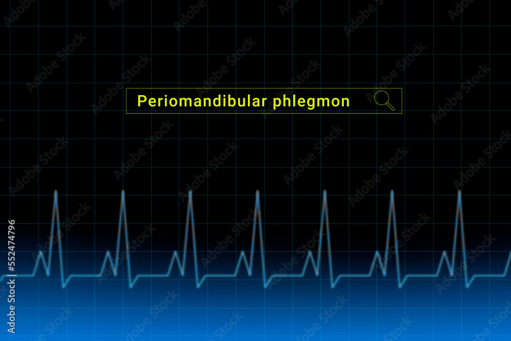 Periomandibular phlegmon.Periomandibular phlegmon inscription in search bar. Illustration with titled Periomandibular phlegmon . Heartbeat line as a symbol of human disease. Periomandibular phlegmon.Periomandibular phlegmon inscription in search bar. Illustration with titled Periomandibular phlegmon . Heartbeat line as a symbol of human disease.