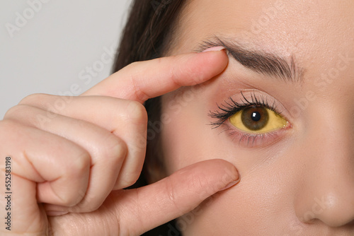 Woman with yellow eyes on light background, closeup. Symptom of hepatitis photo