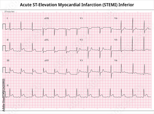 Acute ST-Elevation Myocardial Infarction (STEMI) Inferior - ECG Paper 12 Lead