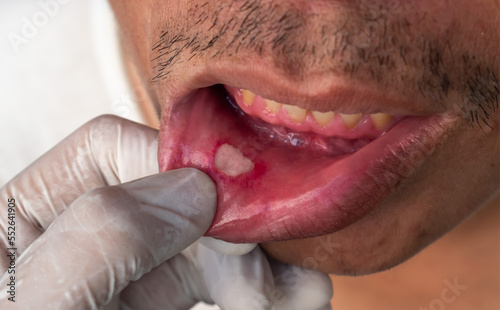 Aphthous ulcer, canker sore or stress ulcer in the mouth of Asian male patient. photo