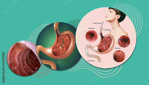 Εκτύπωση καμβά Digestive endoscopy or gastroscopy