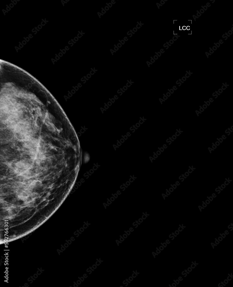 Xray Digital Mammogram or mammography of both side breast showing