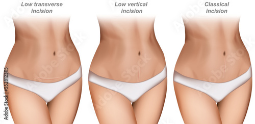 Caesarean section scar. Low vertical incision, Classical incision, Low transverse incision. Sutures Types after of incisions in cesarean delivery. C-section or caesarean delivery