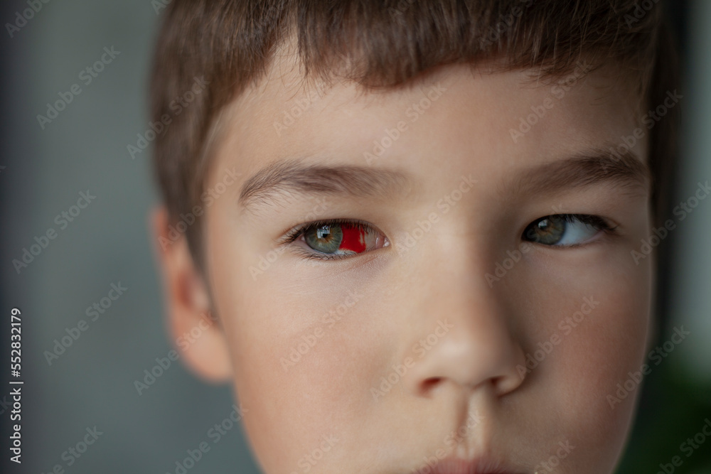 close-up of the boy's face with a red spot on the eyeball close-up of the boy's face with a red spot on the eyeball