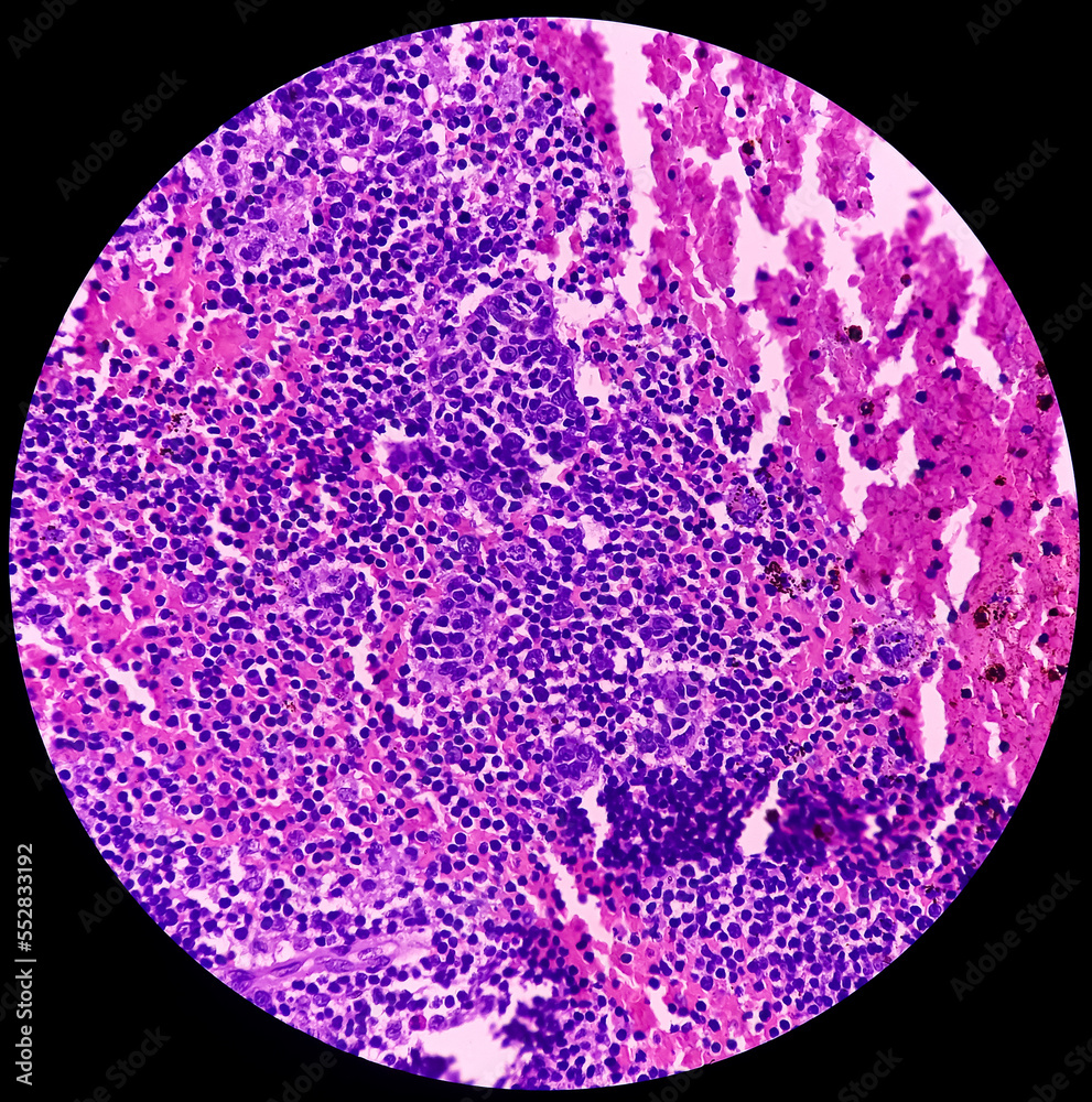 High grade mucoepidermoid carcinoma of parotid cyst. Microscopic show ...