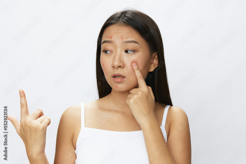 Asian woman facial skin problems, acne and inflammation, red rashes and allergies, chicken pox, sadness from rashes. Facial skin care concept for diseases and nerves Asian woman facial skin problems, acne and inflammation, red rashes and allergies, chicken pox, sadness from rashes. Facial skin care concept for diseases and nerves