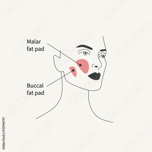 Removal of malar fat pad and buccal fat pad photo