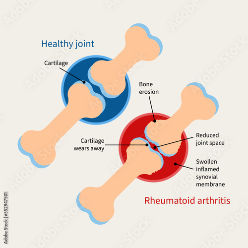 Rheumatoid arthritis illustration