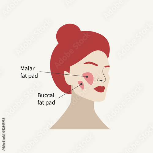Removal of malar fat pad and buccal fat pad