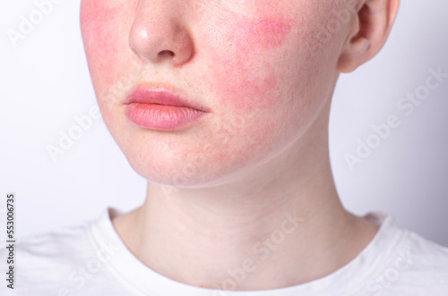 rosacea couperose redness skin, red spots on cheeks, young woman with sensitive skin, patient face close-up  photo