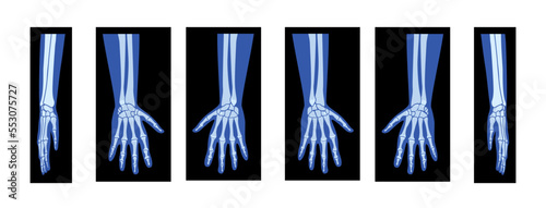 Set of X-Ray Hands with Radius, Ulna Skeleton Human body, Bones adult people roentgen front back side view. 3D realistic flat blue color concept Vector illustration of medical anatomy isolated