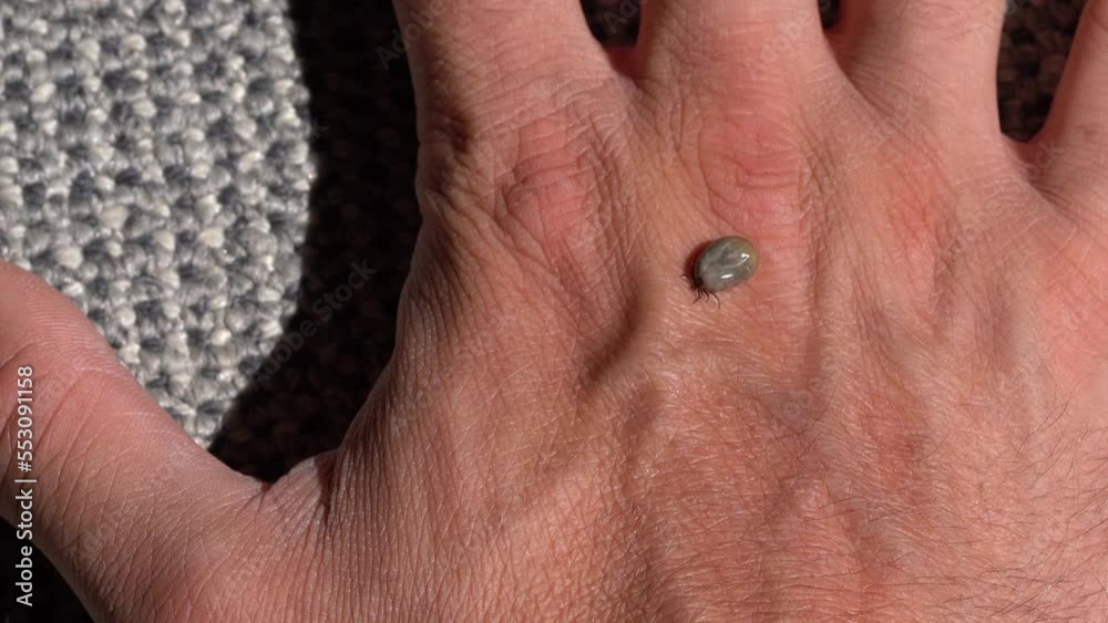 Man Remove Huge Tick Full of Blood Crawling On Male Human Hand - Close Up Man Remove Huge Tick Full of Blood Crawling On Male Human Hand - Close Up