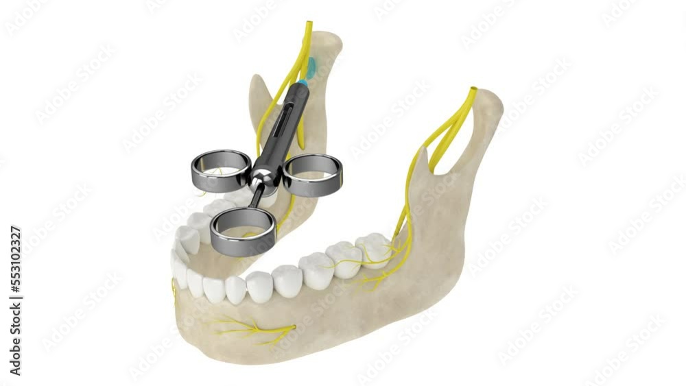 Mandibular arch with gowgates nerve block. Types of dental anesthesia