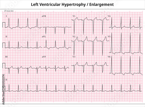 ECG Left Ventricular Enlargement - ECG Paper 12 Leads - Left Ventricular Hypertrophy