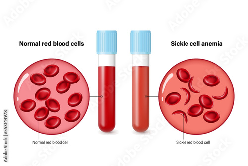 Close up of Normal red blood cells and Sickle cell anemia. Sickle cell disease.