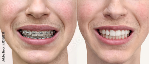 Teeth of a teenage boy before and after dental braces treatment. Close-up. Health care and medical concept.