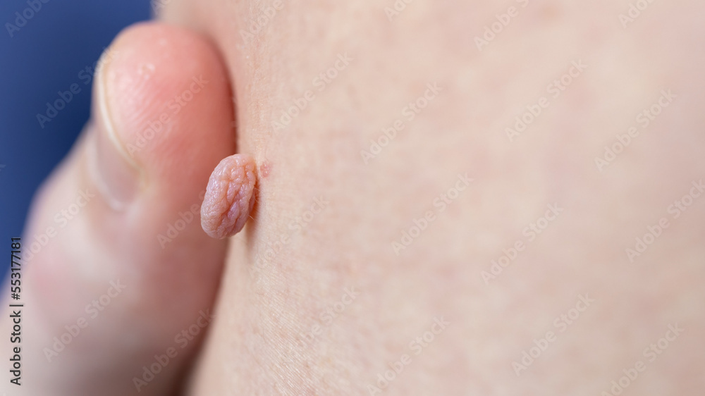 Close-up of large rashes or smallpox on the skin of an adult male ...