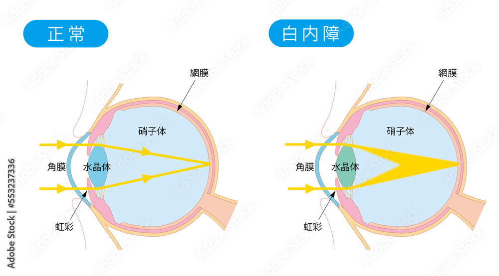 正常な目と白内障の目の断面 Stock イラスト | Adobe Stock