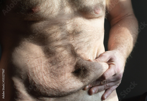 Person after losing weight with loose skin in stretch marks, close up on the skin and the body, healthy lifestyle theme. photo