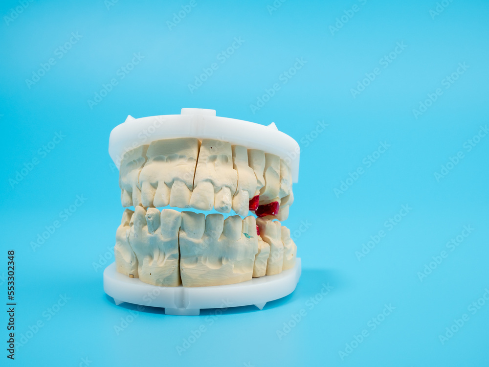 Dental casts on a blue background. Plaster model of teeth.