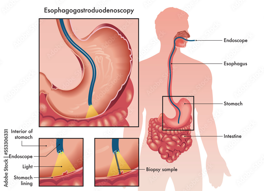 Medical illustration of an Esophagogastroduodenoscopy with two details
