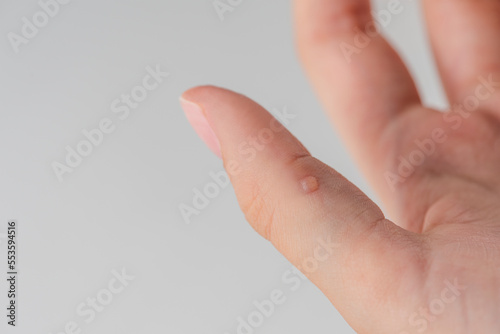 Wart on hand. The concept of treating warts and other skin defects. Close-up of a wart on a finger, a benign growth on human skin.