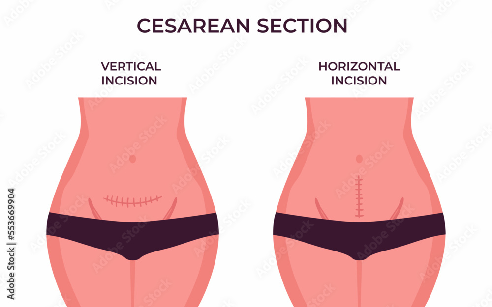 Single Y Incision Plagát Horizontal and Vertical Incision Types of incisions in cesarean ...