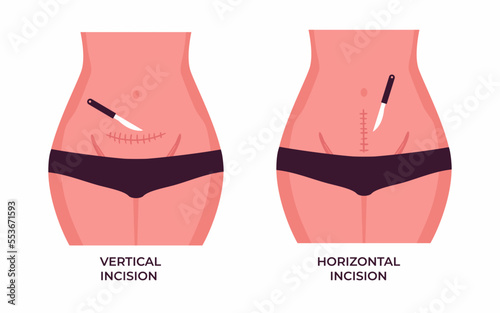 Stomach of a woman with a vertical and horizontal cesarean scar, type of c section vector illustration.