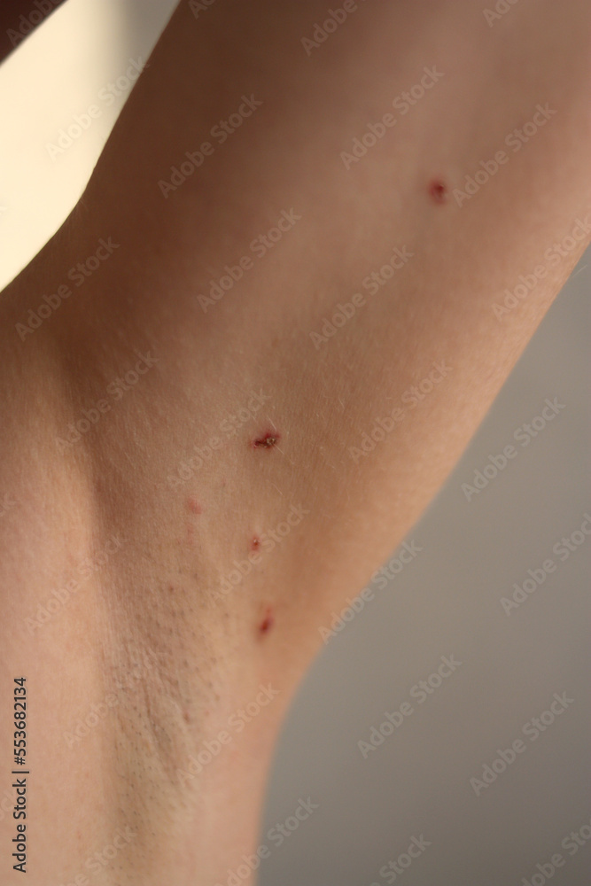 The skin on the armpits after removal of papillomas by laser