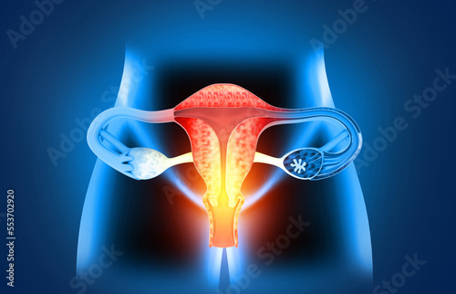 Female reproductive system diseases. Uterus cancer and endometrial malignant tumor as a uterine medical concept. 3d illustration
