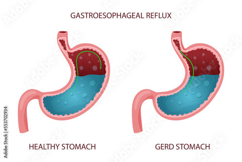 Healthy stomach and gastroesophageal reflux disease illustration