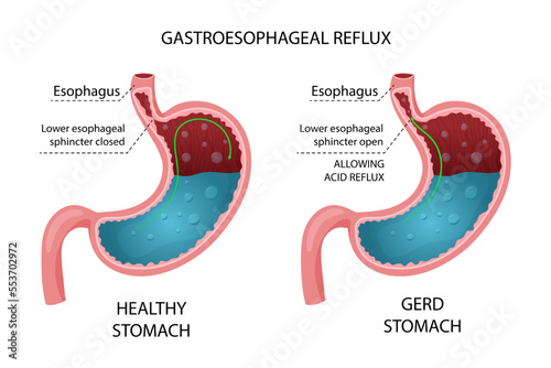Healthy stomach and GERD infographic