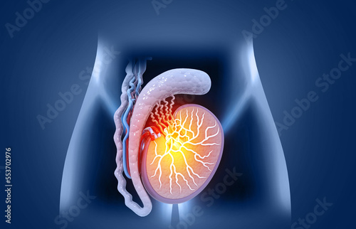 Testicular disease, Testicular lymphoma, cross section. 3d illustration