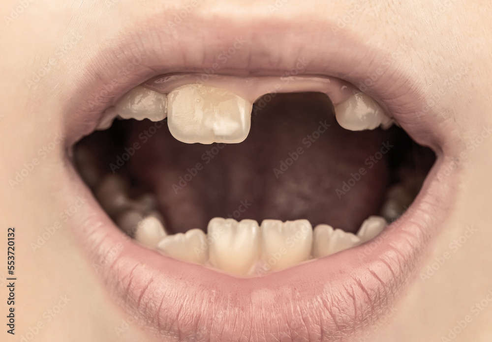 Fototapeta premium Close up of unhealthy baby teeths. Kid patient open mouth showing cavities teeth decay