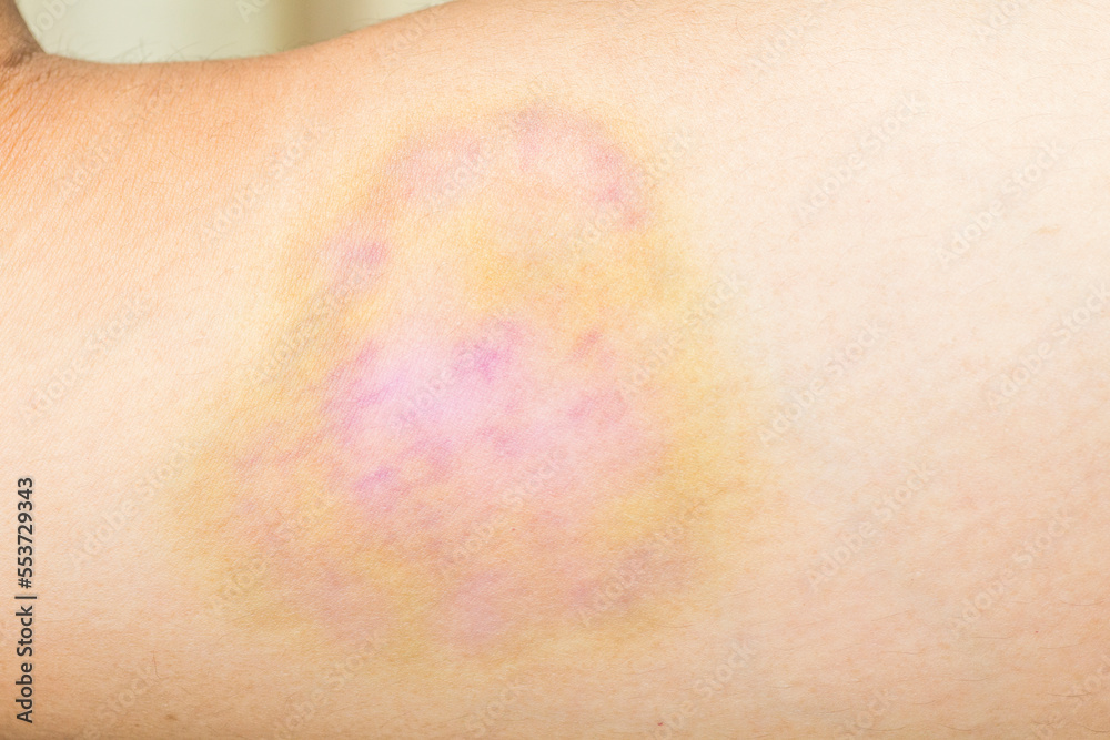 Closeup on a Bruise on wounded arm skin. Gender violence concept Closeup on a Bruise on wounded arm skin. Gender violence concept
